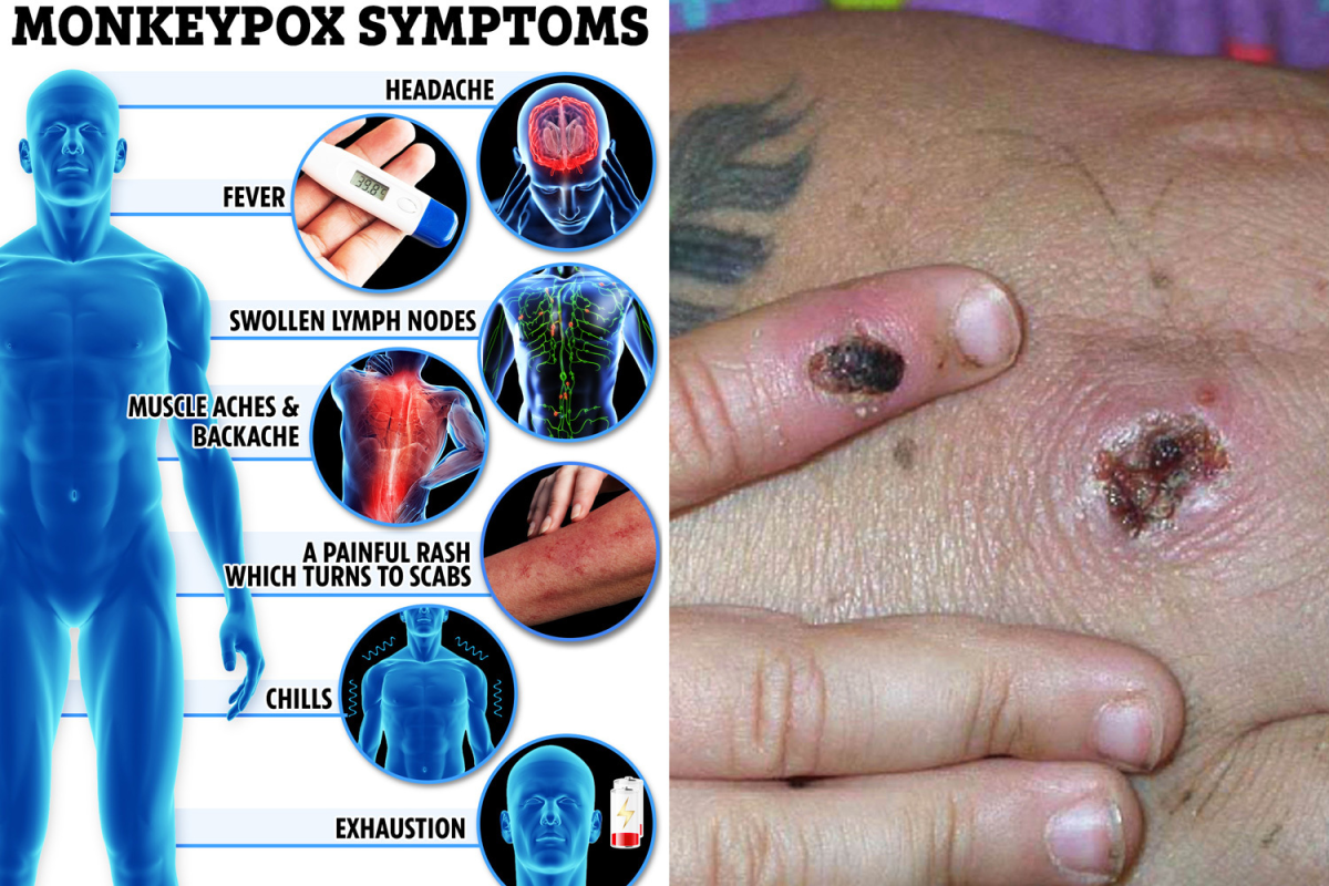 Epidemic Watch: The Status and Future of Monkeypox in the United States