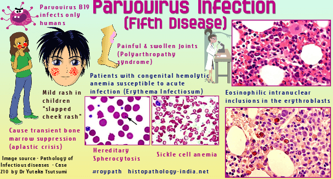 2024 Parvovirus B19 Surge: Causes, Impact, and Response in the U.S.